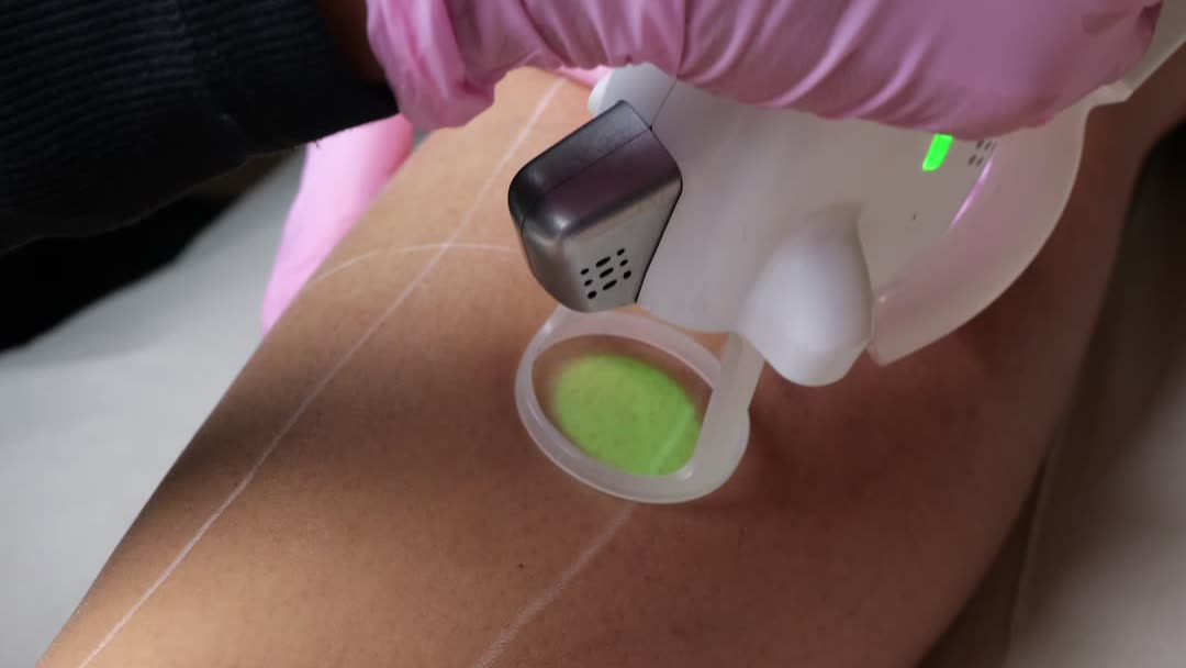 Clarity2 laser hårborttagning hos Lemoge Clinic Uppsala